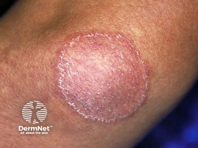 Micose (tinea corporis) na pele, com o anel vermelho característico de borda escamosa e centro mais claro.